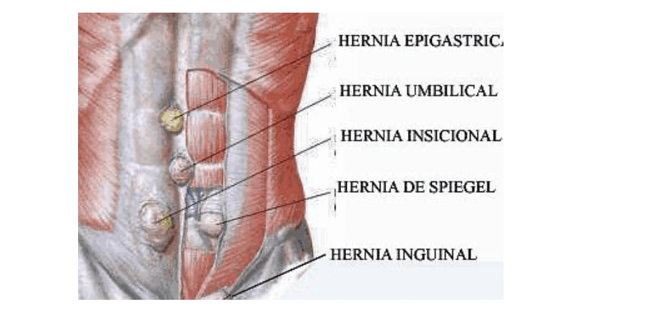 hernia-spiegel - IOCir